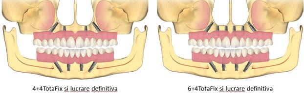 Lucrare definitivă fixă pe implanturi, cu extensii posterioare de maximum două masele pe fiecare parte