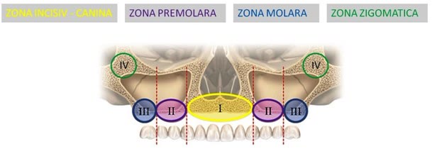 Cele patru zone osoase maxilare: zona I incisiv-canină, zona II premolară, zona III molară și zona IV zigomatică