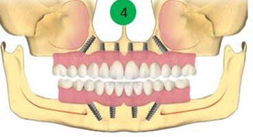 Lucrare definitivă fixă pe implanturi, realizată după osteointegrare