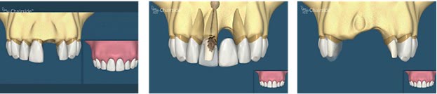 Comparație între implantul dentar pentru un dinte și puntea dentară sprijinită pe dinții vecini