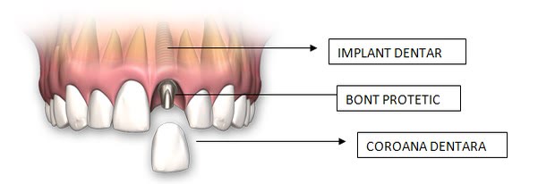 Înlocuirea unui singur dinte lipsă cu implant dentar și coroană, comparativ cu spațiul edentat