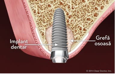 Implant dentar integrat în os regenerat, cu coroana definitivă montată
