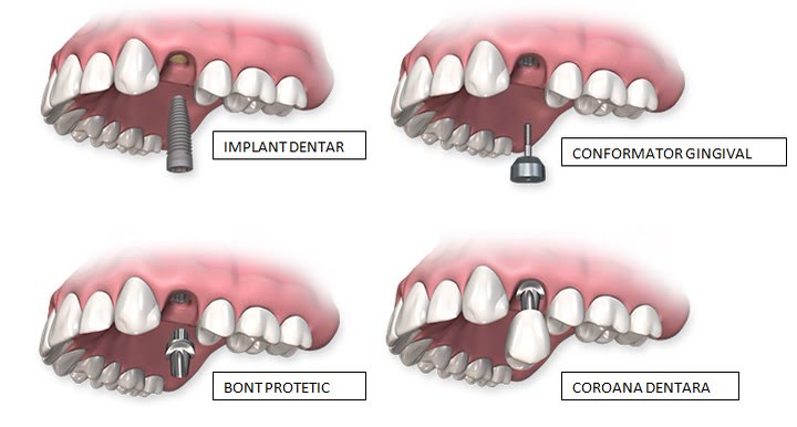 Etapele realizării unui implant unidentar: forarea canalului în os, inserarea implantului și atașarea coroanei