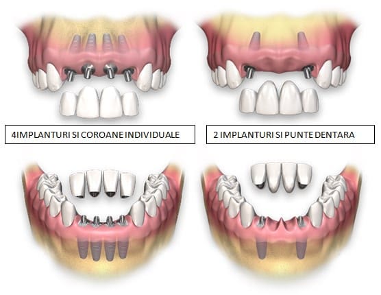 Variante de înlocuire a mai multor dinți lipsă: patru implanturi cu coroane individuale și două implanturi cu punte dentară