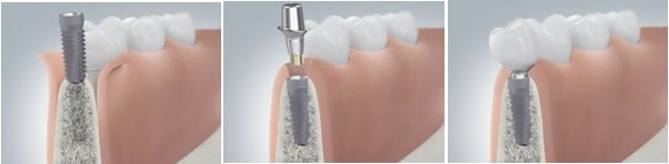 Etapele inserării unui implant: implantul în os, montarea bontului protetic și coroana finalizată
