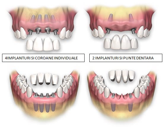 Variante de înlocuire a mai multor dinți lipsă: 4 implanturi cu coroane individuale sau 2 implanturi cu punte dentară, la maxilar și la mandibulă