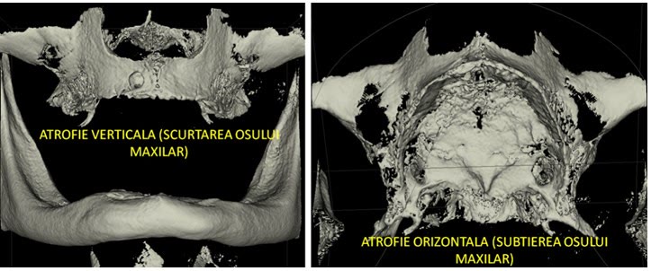 Reconstrucții CBCT care arată atrofia verticală (scurtarea osului) și atrofia orizontală (subțierea osului)