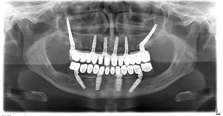 Radiografie panoramică a unei reabilitări cu implanturi convenționale anterioare și două implanturi zigomatice posterioare