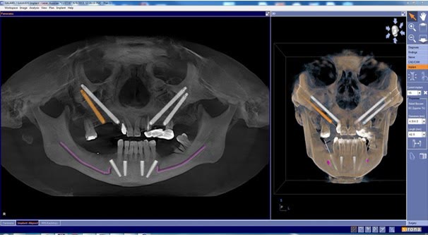 Planificare virtuală pe tomografia dentară: poziția implanturilor zigomatice și a implanturilor convenționale, în secțiune și în reconstrucție 3D