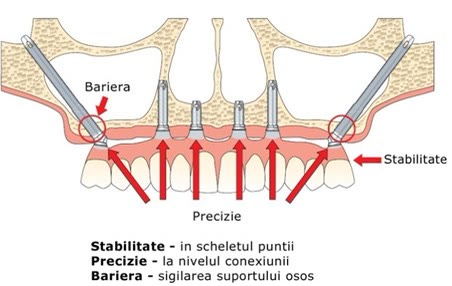 Schemă a rolului implanturilor zigomatice: stabilitate în scheletul punții, precizie la nivelul conexiunii și barieră prin sigilarea suportului osos