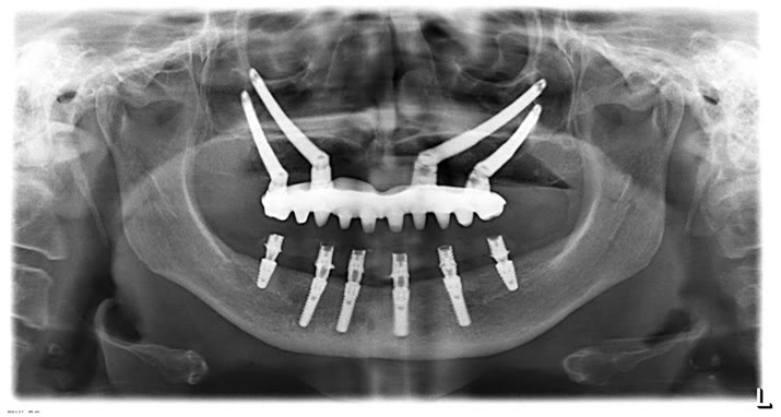 Radiografie panoramică a unei reabilitări QuadZygoma, cu patru implanturi zigomatice la maxilar