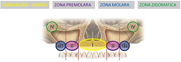 Cele patru zone de os maxilar: zona I incisiv-canină, zona II premolară, zona III molară și zona IV zigomatică
