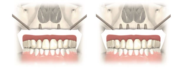 Implanturi convenționale anterioare combinate cu câte un implant zigomatic pe fiecare parte, conceptul TotalFix+