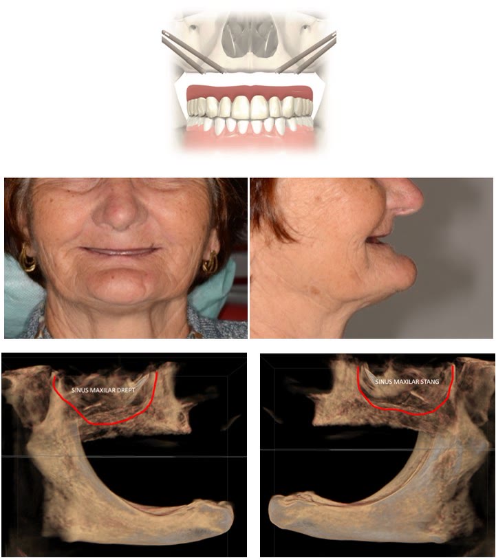Reabilitare fixă pe implanturi zigomatice: schema implanturilor, aspectul facial al pacientei și reconstrucțiile CBCT ale sinusurilor maxilare drept și stâng