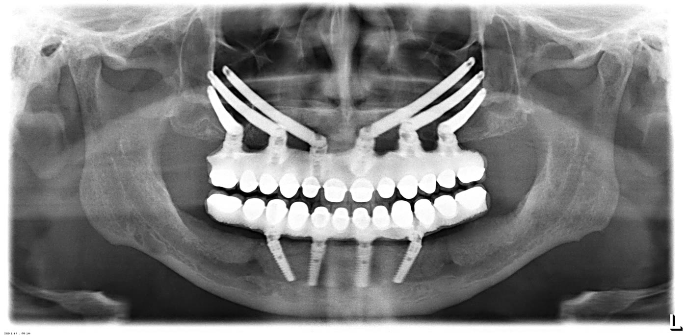 Radiografie panoramică a unei reabilitări SixZygoma, cu șase implanturi zigomatice la maxilar și implanturi convenționale la mandibulă