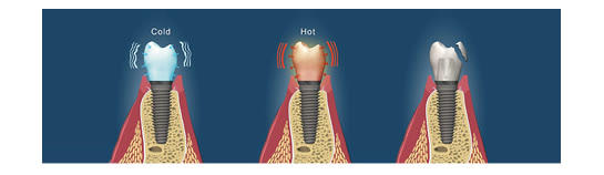 Coroana pe implant expusă la rece, apoi la cald, și coroana fisurată în urma alternanței de temperatură
