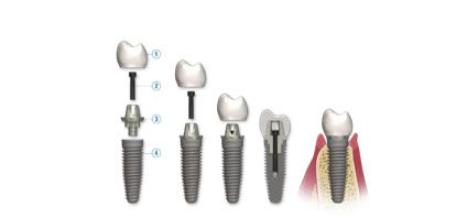 Componentele complexului implantar numerotate: coroana artificială, șurubul, bontul protetic și implantul dentar