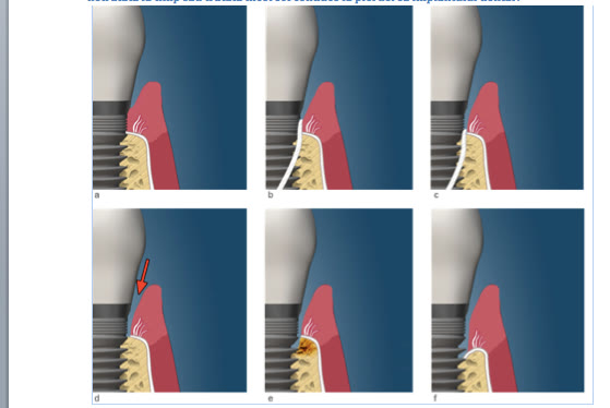 Serie de șase imagini (a–f) care arată sigiliul gingival în jurul implantului, utilizarea prudentă și cea viguroasă a aței dentare, deschiderea spațiului protector și pierderea osului periimplantar