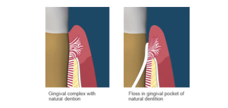 Complexul gingival al unui dinte natural și ața dentară introdusă în punga gingivală a dintelui natural