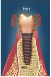 Schemă a unui implant dentar care înmagazinează căldura primită de la un lichid fierbinte