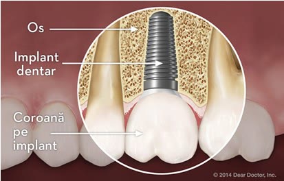 Secțiune ilustrată prin os cu un implant dentar și coroana fixată pe implant, între doi dinți naturali intacți