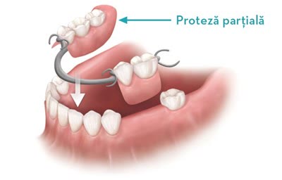 Ilustrație a unei proteze parțiale mobile care se sprijină cu croșete pe dinții naturali rămași