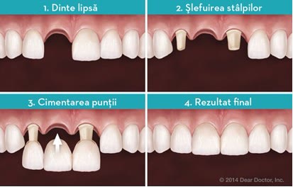 Cele patru etape ale unei punți dentare: dinte lipsă, șlefuirea stâlpilor, cimentarea punții și rezultatul final