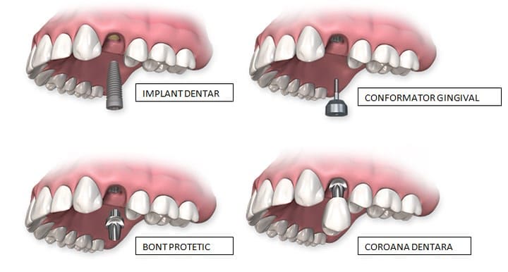 Cele patru etape ale unui implant pentru un singur dinte: implantul dentar, conformatorul gingival, bontul protetic și coroana dentară
