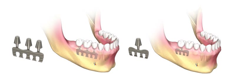Implant dentar tip lamă — nu se mai utilizează
