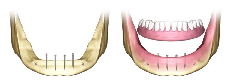 Implanturi dentare și alte tipuri de lucrări pe implant