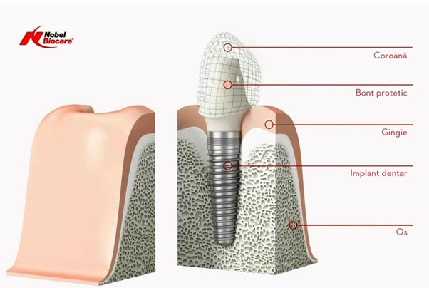 Componentele implantului dentar: implant, bont protetic și coroană