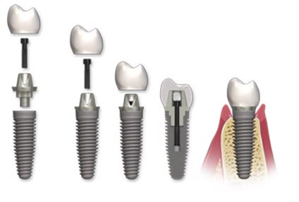 Lucrare dentară cimentată pe implant