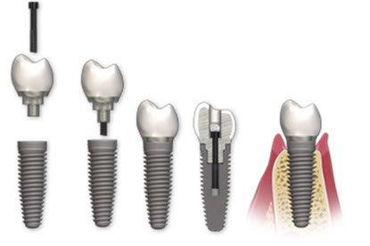 Lucrare dentară înșurubată pe implant