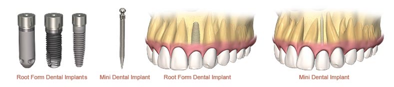 Miniimplanturi dentare