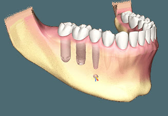 Schemă comparativă cu tipurile de implanturi dentare