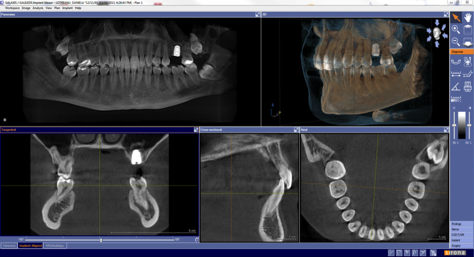 Interfața tomografului dentar Sirona Galileos: radiografie panoramică, reconstrucție 3D și secțiuni tangențiale, transversale și axiale ale maxilarelor