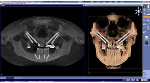 Reconstrucție tridimensională a craniului pe tomografia dentară, cu implanturile din maxilarul superior și din mandibulă vizibile în os