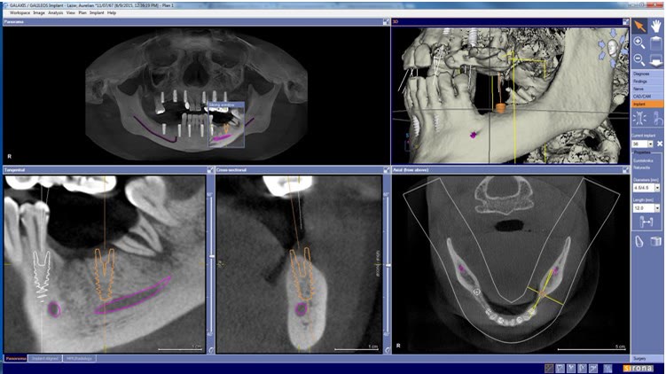 Planificarea virtuală a unui implant dentar în mandibulă: conturul implantului suprapus pe secțiunile tomografice, cu nervul mandibular marcat și diametrul și lungimea alese