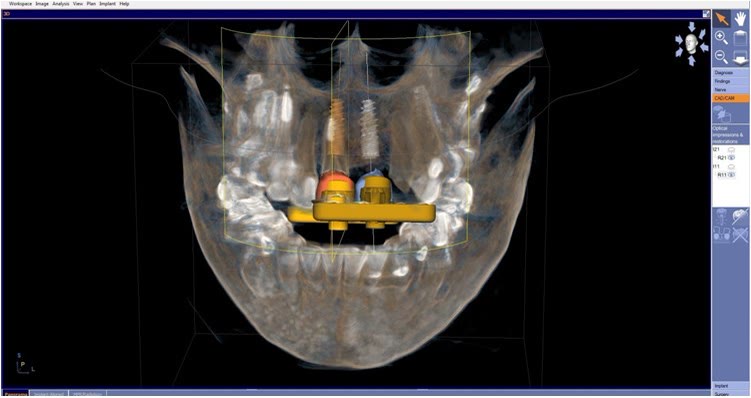 Reconstrucție 3D a maxilarului superior cu două implanturi planificate virtual și bara protetică poziționată pe acestea