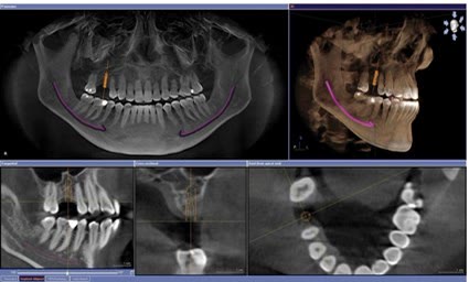 Traseul nervului mandibular marcat cu violet pe radiografia panoramică și pe reconstrucția 3D a tomografiei dentare