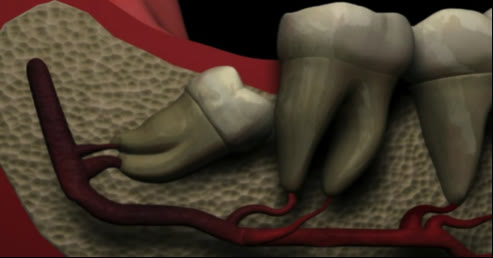 Ilustrație a unui molar de minte inferior inclus orizontal în os, blocat în spatele molarului doi, în vecinătatea nervului alveolar