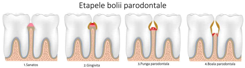 Etapele bolii parodontale ilustrate comparativ: parodonțiu sănătos, gingivită, pungă parodontală și boală parodontală avansată