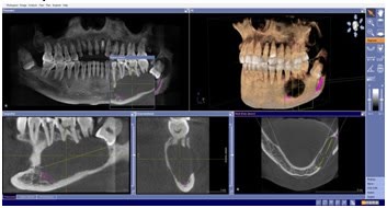 Planificare virtuală pe tomografia dentară: secțiuni 3D cu un chist localizat în vecinătatea unui molar inferior