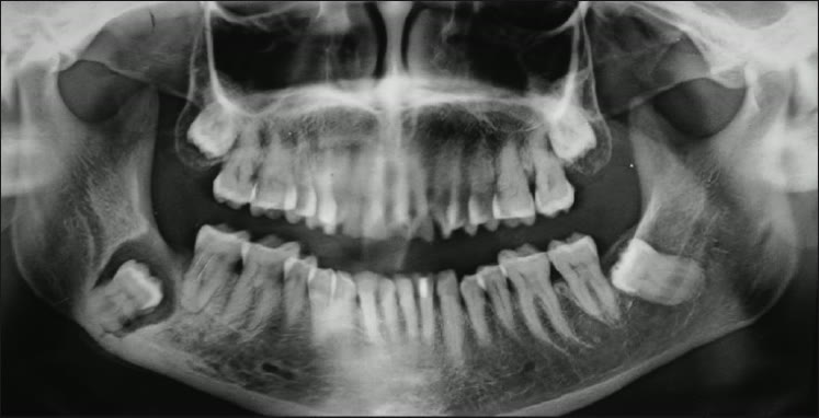 Radiografie panoramică a ambelor maxilare, în care se văd molarii de minte incluși în zonele posterioare, lângă molarii vecini
