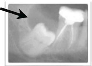 Radiografie de detaliu în care o săgeată indică zona de os pierdut din spatele molarului al doilea, în vecinătatea molarului de minte
