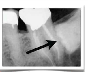 Radiografie în care o săgeată indică punga parodontală formată între molarul de minte și rădăcina molarului vecin