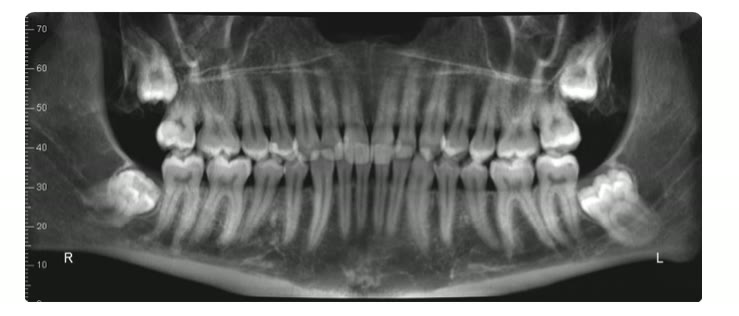 Radiografie panoramică pe care se văd cei patru molari de minte și vecinătatea sinusurilor maxilare
