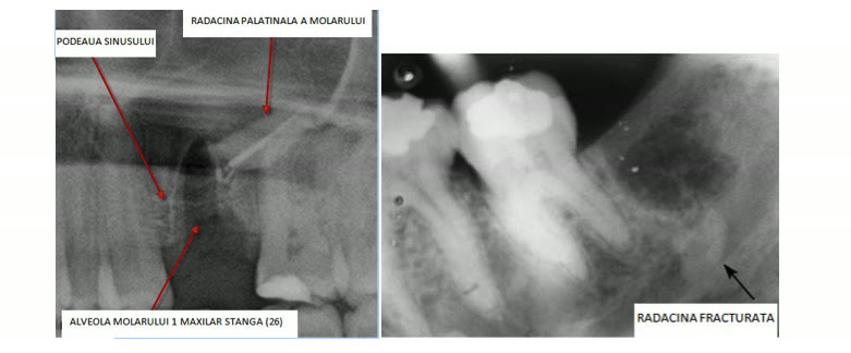 Două radiografii cu podeaua sinusului, rădăcina palatinală a molarului, alveola molarului 1 maxilar stânga și o rădăcină fracturată
