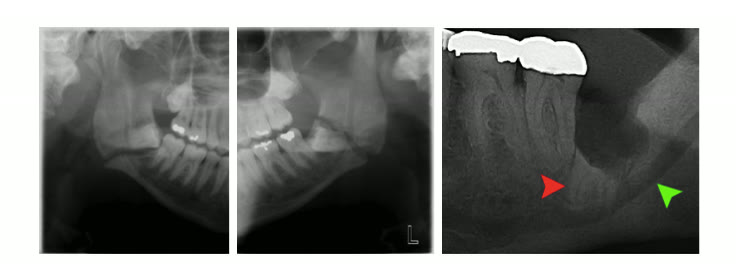 Trei radiografii ale mandibulei cu traiectul unei fracturi marcat prin repere colorate