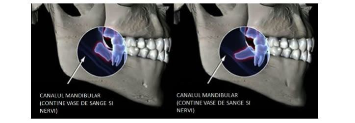 Reconstrucții 3D ale mandibulei cu canalul mandibular evidențiat — conține vase de sânge și nervi